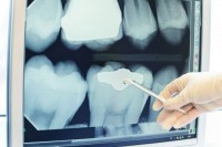 Stomatolozi dječaku izvadili 526 zuba iz vilice VIDEO