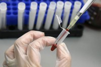 Test krvi koji otkriva sepsu za svega 10 minuta