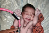 Индија: Бебу рођену са четири руке и ноге прогласили реинкарнацијом Бога