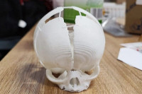Beba spašena nakon što je 3D printerom napravljen dio lobanje