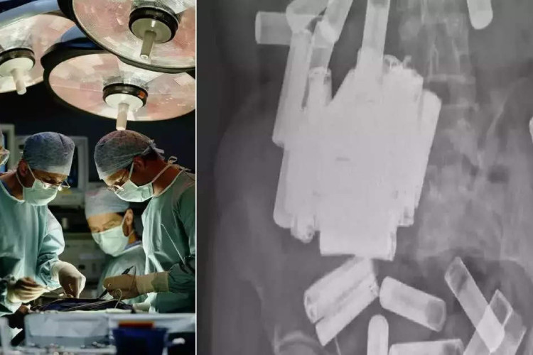Irski hirurzi iz stomaka žene izvadili više od 50 baterija - Glas Srpske