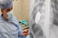 Хирурзи из груди украјинског војника уклонили неексплодирану гранату