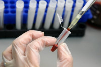 Научници развили тест из крви за мjерење степена анксиозности