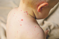 Троје дјеце у Бијељини заражено морбилима: Из Института позивају на вакцинацију