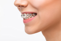 Неправилан загриз зуба: Зашто настаје и како се лијечи