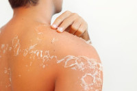 Ovo trebate da uradite ako vam se koža ljušti poslije sunčanja
